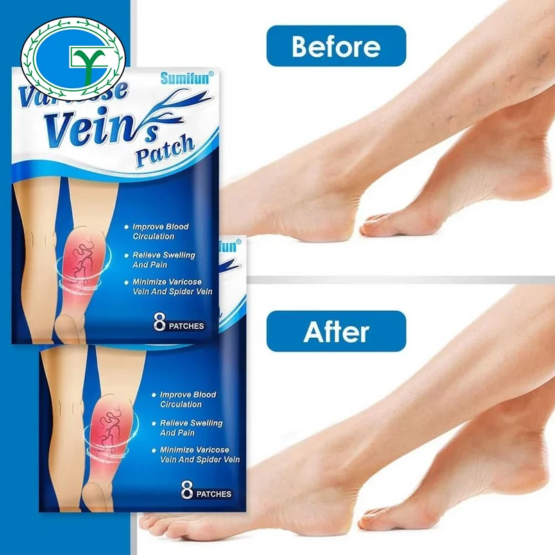 Sumifun 8pcs/bag Chinese Varicose Veins Plaster Vasculitis Phlebitis Spider Leg Medical Patch Angiitis Removal Patch