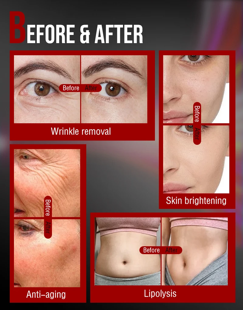 2940nm 4D pro vaginal rejuvenation tightening scar removal 1064nm fractional laser machine for removal pigmentation