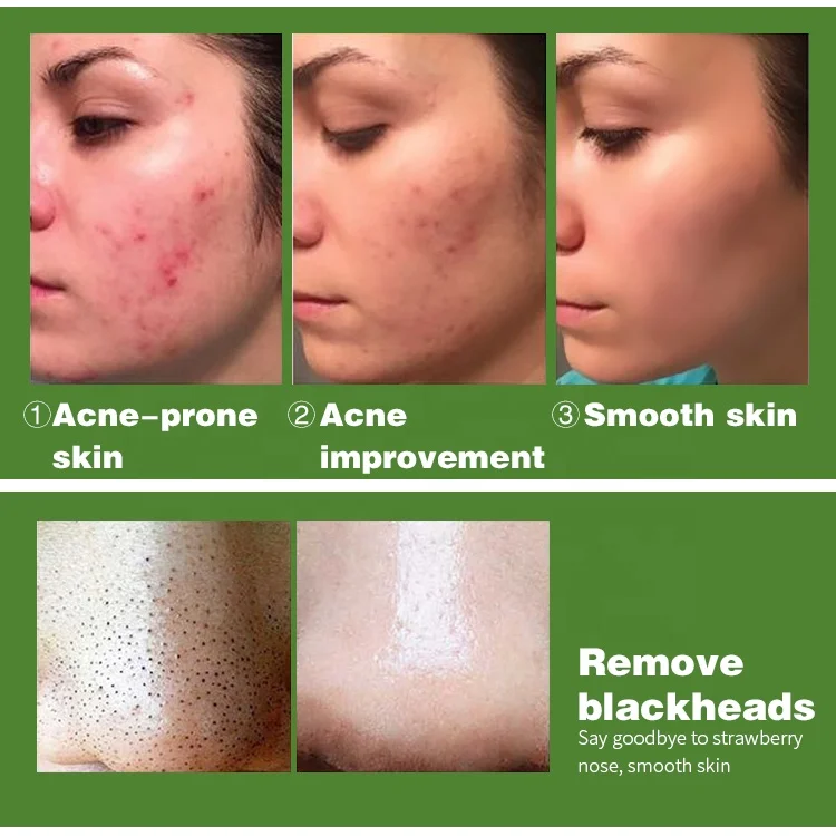ailke wholesale best salycilic acid acne pimple face brightening anti-acne serum facial