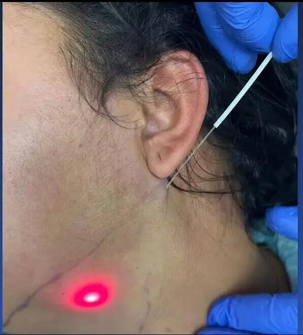 Fiber Endolaser Lipolysis Facial Body Lifting 980 1470nm Diode Laser Liposuction Canulas Fat Dissolving Medical Surgical Machine