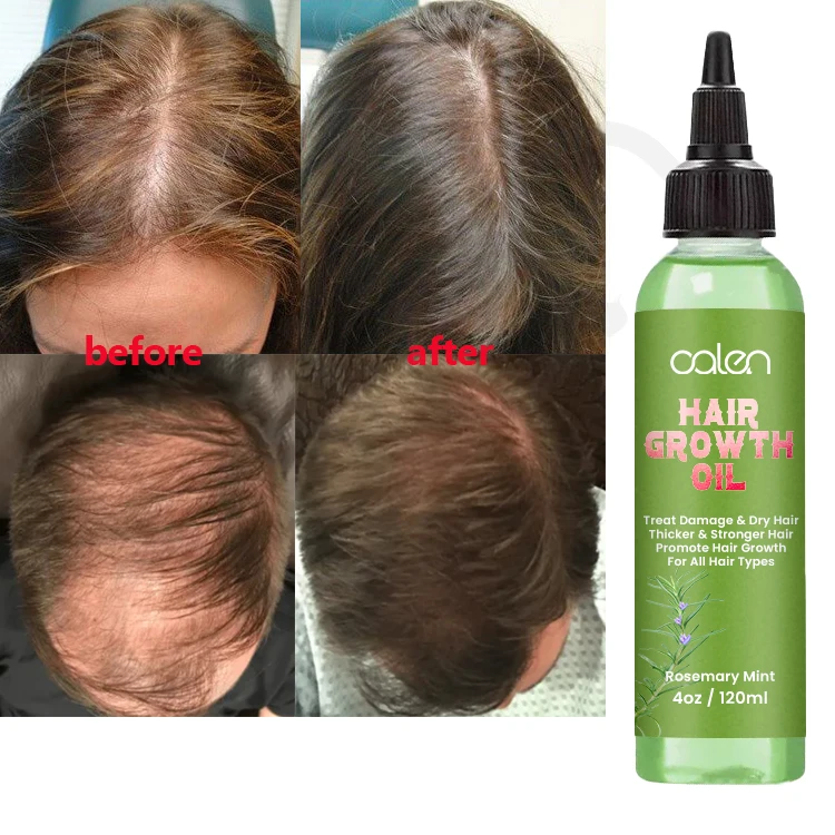 Oalen Hair Care Promote Hair Growth Massage Nourishing Saver Relieve Scalp Tension Refreshing Mint Scalp Oil