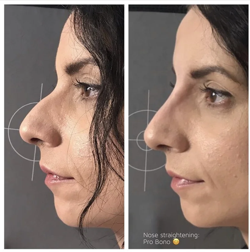 
Hot Sale otesaly 2ml Deep dermal Filler Syringe Injectable Hyaluronic Acid 3% Lido skin care injection 