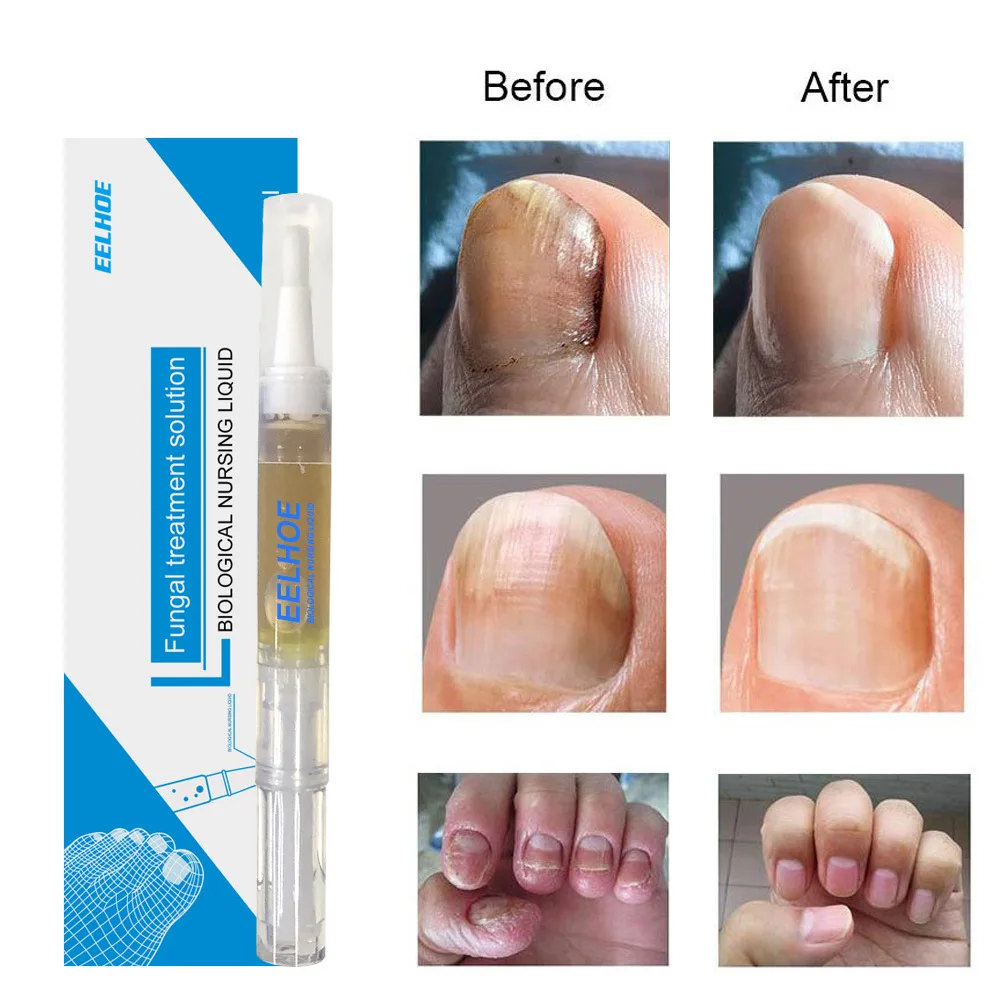 High Quality Nail Treatment Serum Foot Repair Liquid Care Effective Nail Repair Essence