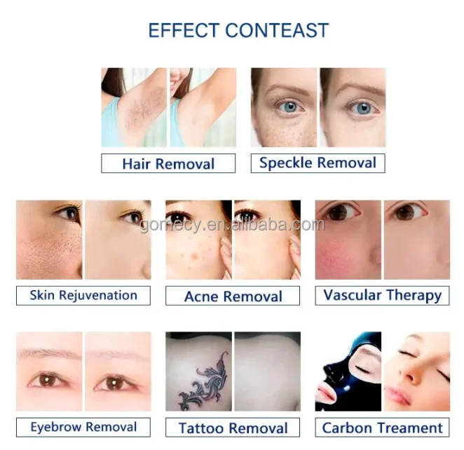 Beauty-Laser-Machine-Aesthetic