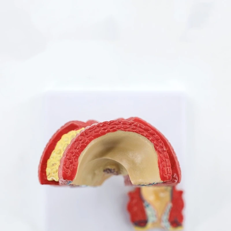 rectal hemorrhoids colorectal disease model Internal and external rectal hemorrhoids anorectal model