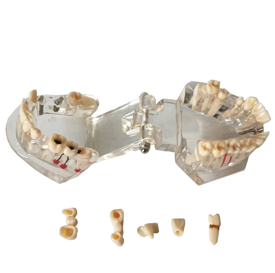 Dental Implant Disease Teeth Models