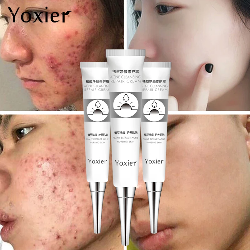 Skin Care Yoxier Remove Acne Pimples Cream Oil Control Acne Cream Face Acne Cream