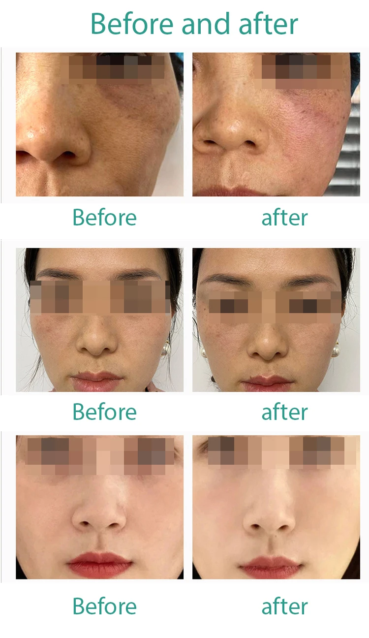 Hot Sale 100u Remove Wrinkle Therapy Serum anti wrinkle Anti aging Lyophilized Freeze Dried powder Serum