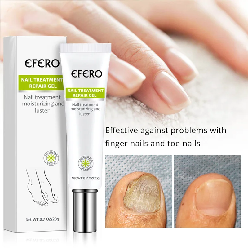 Expel gray nails and toenails special gel new bright nail antibacterial liquid skin care