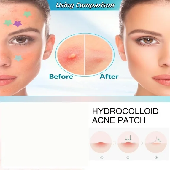 Star Shaped Hydrocolloid Acne Covering Patches Whole Face Care Pimple Patch 60 Spades And 600 Spades Box Convenient Carrying