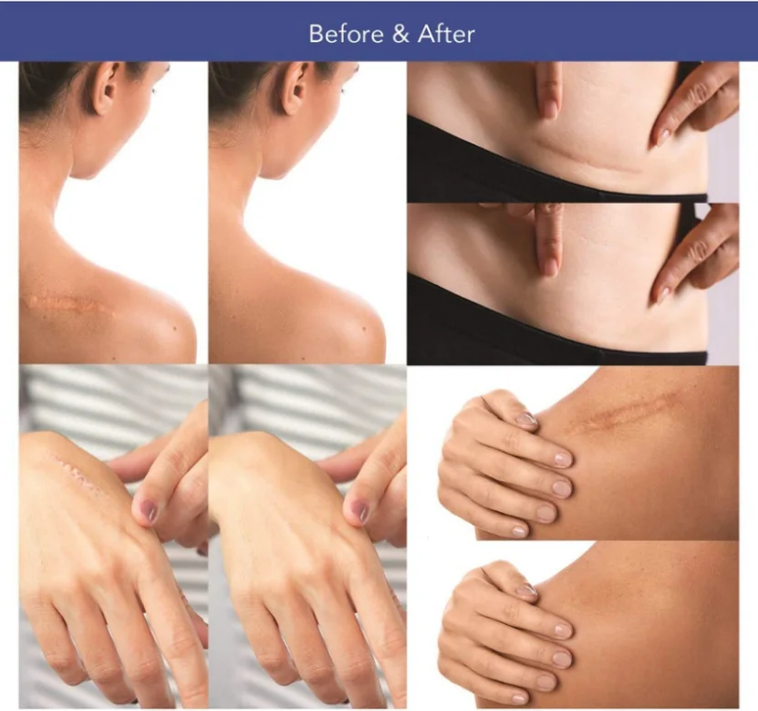 Custom Covering Self Adhesive Surgery Silicone Gel Patch Anti Scar Removal Sheet