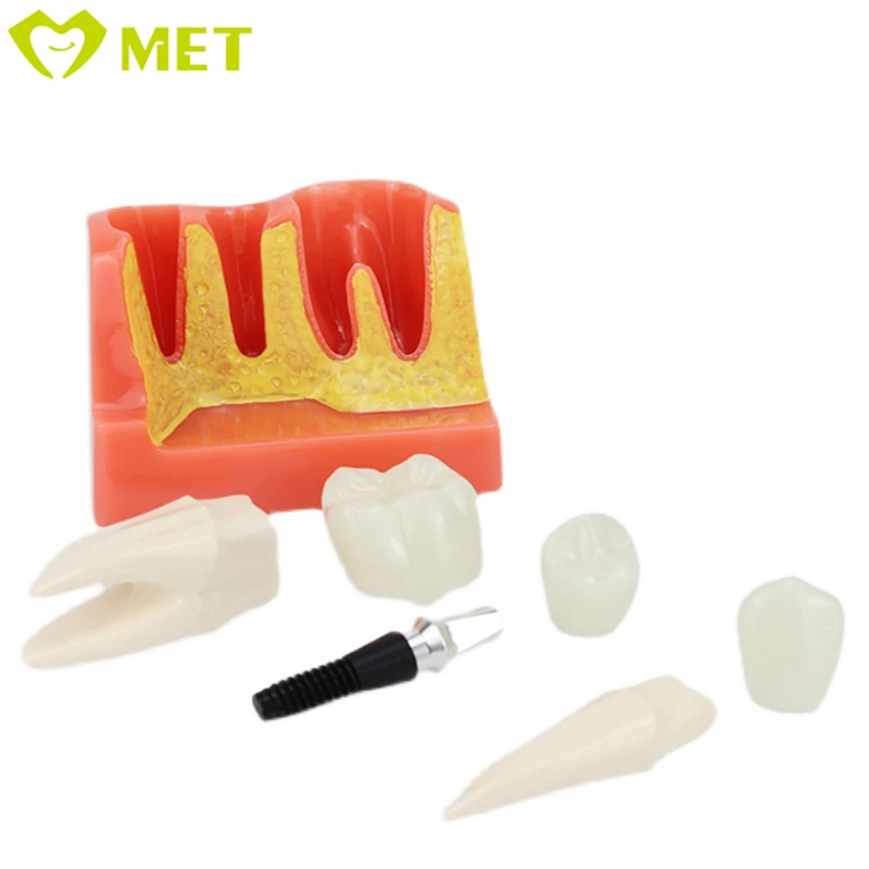 Meite medical 4 Times dental implant model/dental teaching model/dental removable teeth model