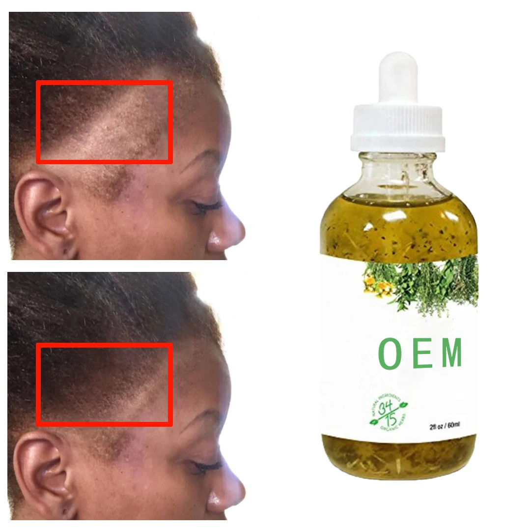 Oem Custom Hair Tonic Smoothing Repairing Anti Loss Regrowth Scalp Elixir Hair Growth Oil Serum