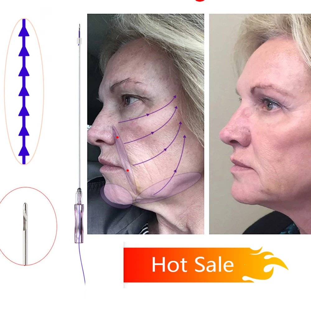 Non-Surgery Absorbable 19G 100mm Blunt W Needle Face Lifting Fishbone Molding Cog Pdo Thread