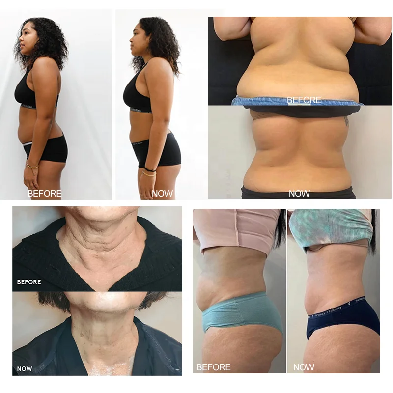 Kryolipolyse body shape slimming cryoslim cool face lift sculpting machine fat removal CRYOSKIN EMS paddles cryo heating t shock