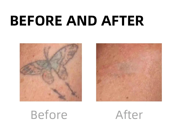 Oem logo Qswitch Lutron Picocare Picosecond q Switched Nd Yag Laser Tattoo Tattoos Picolaser Tattoo Remove Pico Machine Price