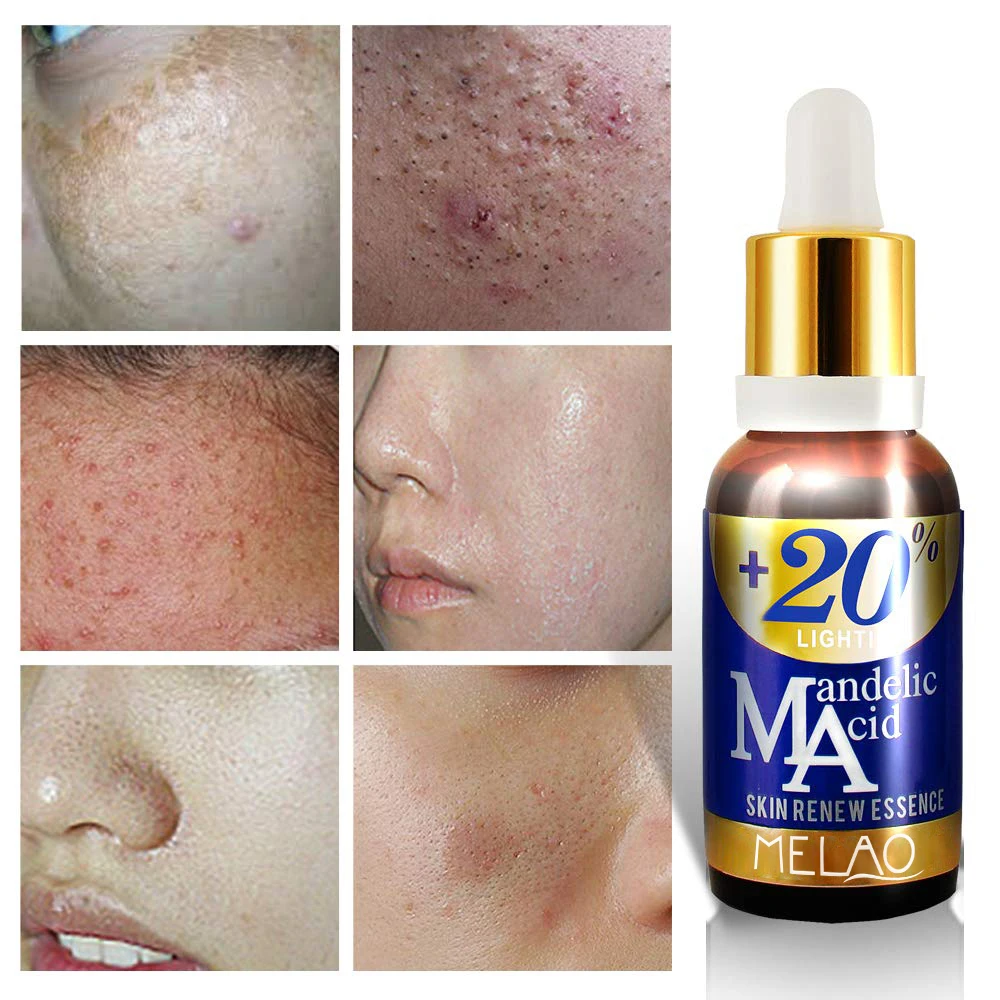 Skin care products mandelic acid serum beauty cosmetics serum anti acne Moisturizing Blemish Mandelic Acid Essential Serum