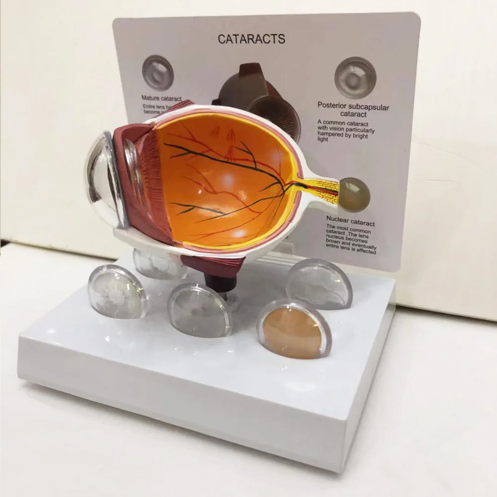 Human eyeball lesion model, pathological glaucoma, cataract anatomical eye lesion model