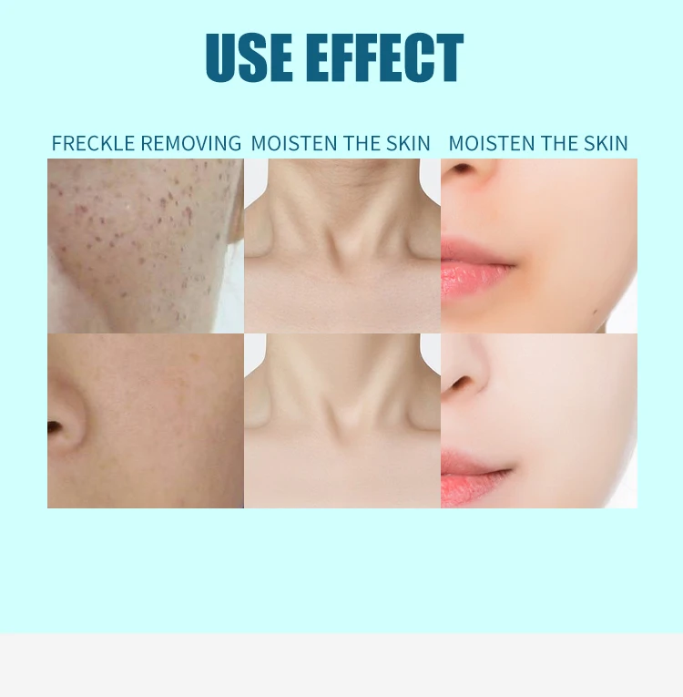 Hot Selling Product Professional Carbon Peel Laser Q Switched Nd Yag Laser Tattoo Removal Machine Beauty Salon