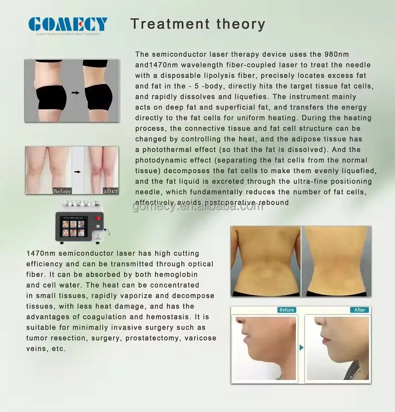 2024-Top-Sales-Most-Effective-Skin-Rejuvenation-Endolaser-Diode-Liposuction-Equipment-980-Nm-1470-