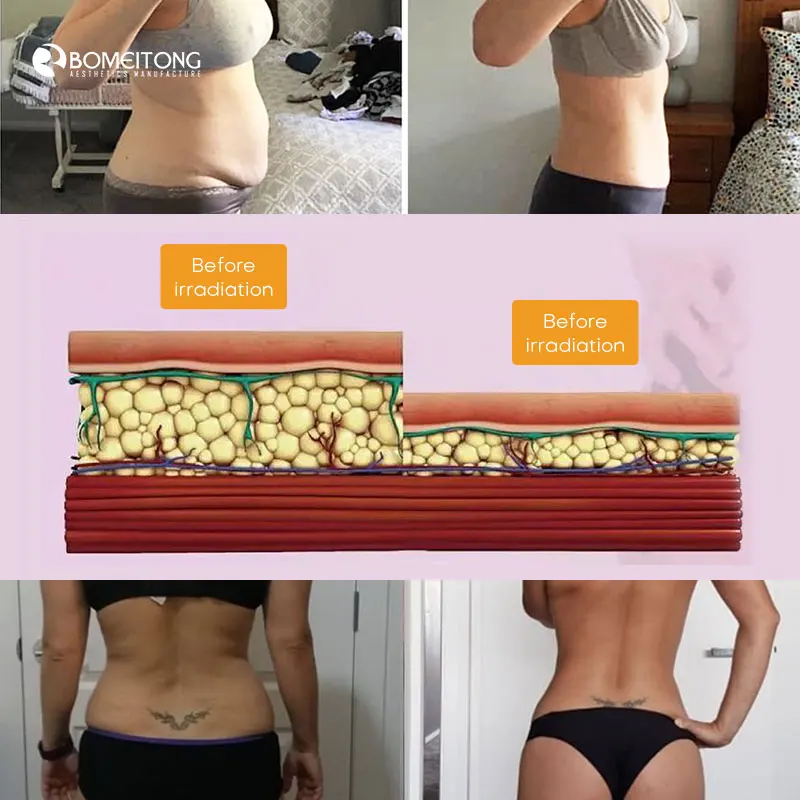 AngieFXSlim weight loss cellulite reduction slimming cold laser 2024 body sculpting fat removal 532nm 10d green laser