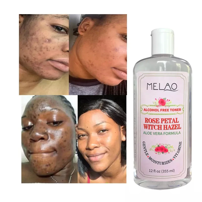 100% чистый натуральный органический уход за кожей тоник с лепестками розы гамамелиса водой пятна удаление акне тонер для