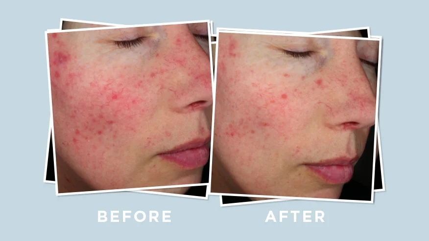 ETRUN ALISA Private Label Natural Azelaic Acid Serum Anti-redness Acne Reduces Hyperpigmentation Spots Controls Sebum Serum