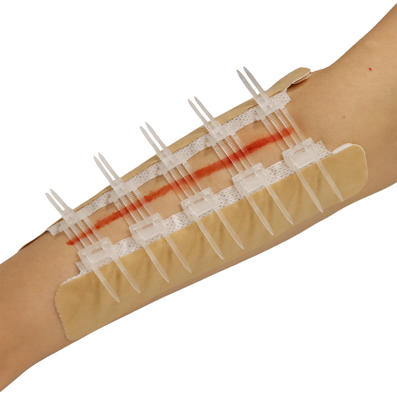 BLUENJOY Sterile Skin Color Wound Closure Device First Aid Wound Care Zip Stitch Wound Device