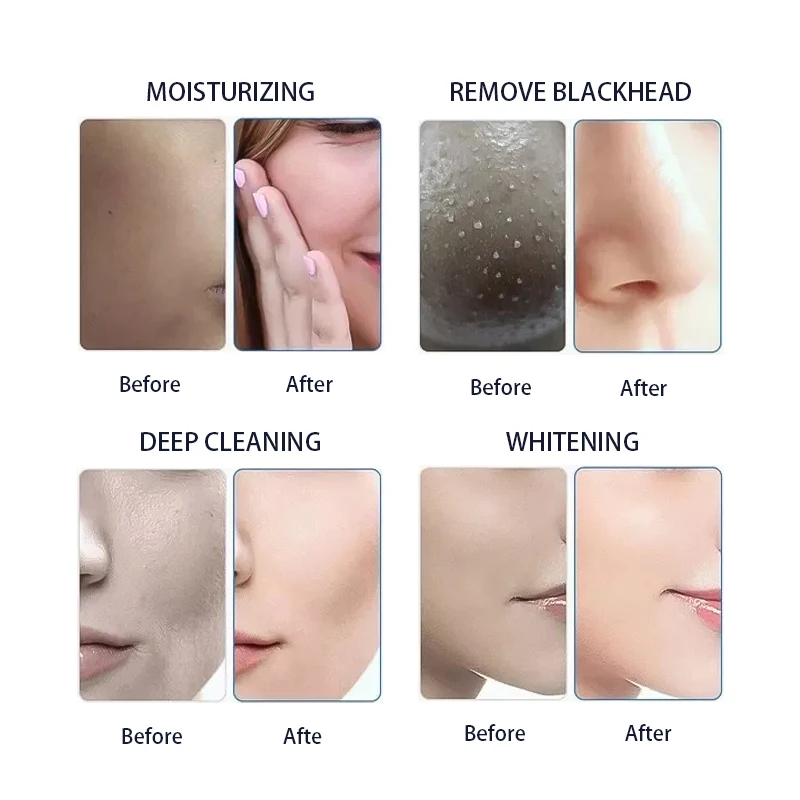 Portable Skin Care Hydra Dermabrasion Oxygen Facial Jet Peel Microdermabrasion Hydrodermabrasion Machine