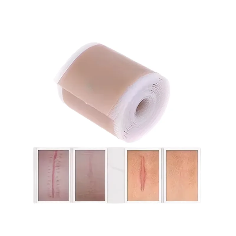 Hot Sale Skin Color Silicone Scar Patches for Medical Treatment Reduce Redness and Itching