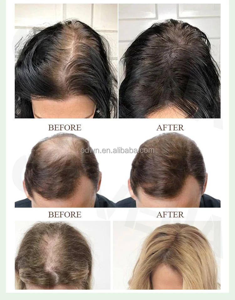 Women Men Anti Hair Loss Treatment Organic Ginger Hair Growth Oil For Hair Regrowth Spray