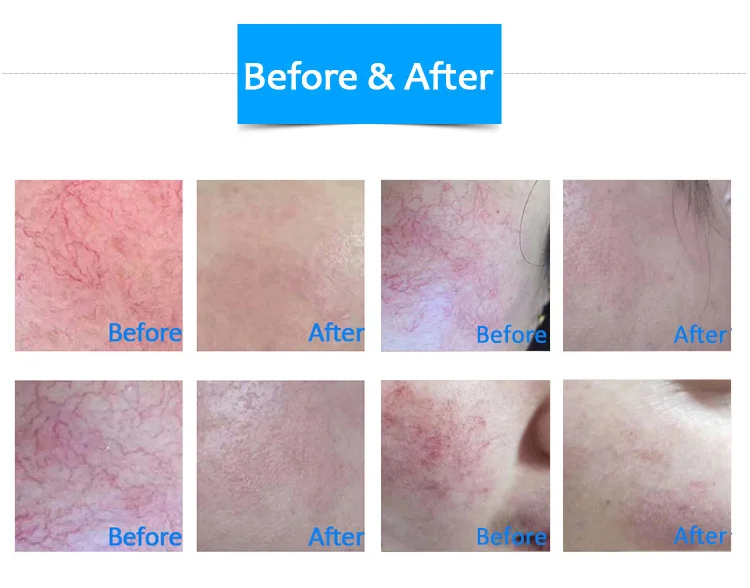 2022 HONKON 908nm skin treatment 15w diode laser for vascular removal Portable 1064nm & 532nm Q-switched machine