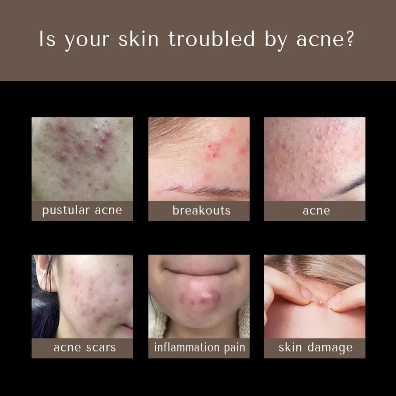 Korean Natural Transparent Face Oil Acne Patches For Covering Zits And Blemishes Private Label