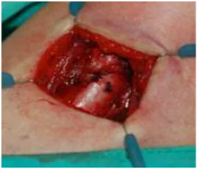 Single Use Retractor Ring Micro Surgery Instruments Set Pediatric Surgery Instrument Pediatric Urology Retractor