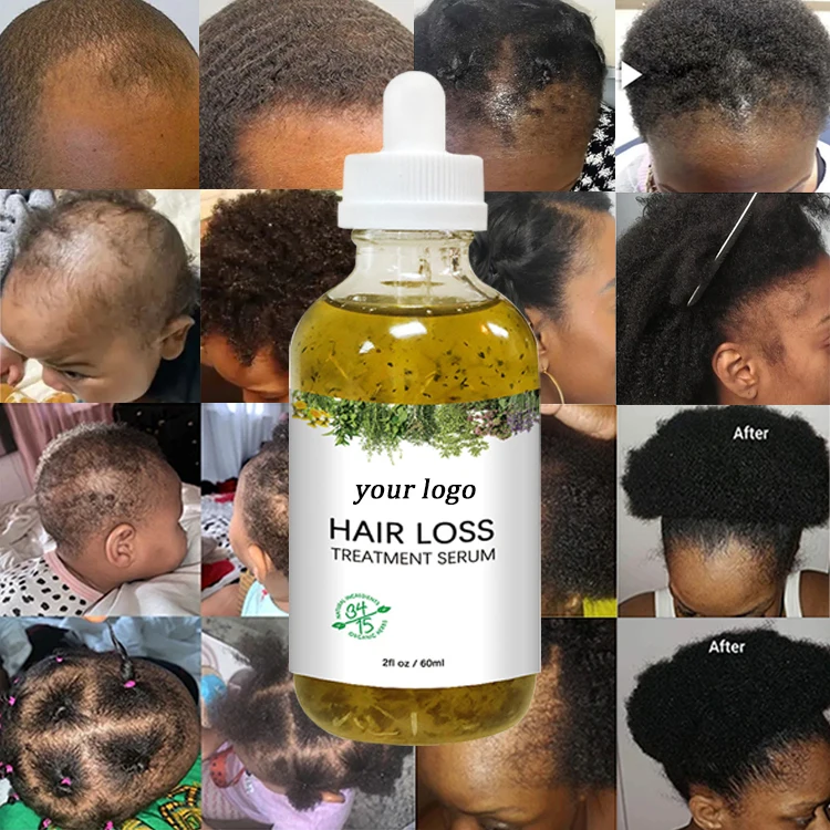 TEIENER Top Selling Products Cheap Dropshipping Organic Anti Hair Loss Serum Fall Ginger Extra Strength Hair Growth Oil