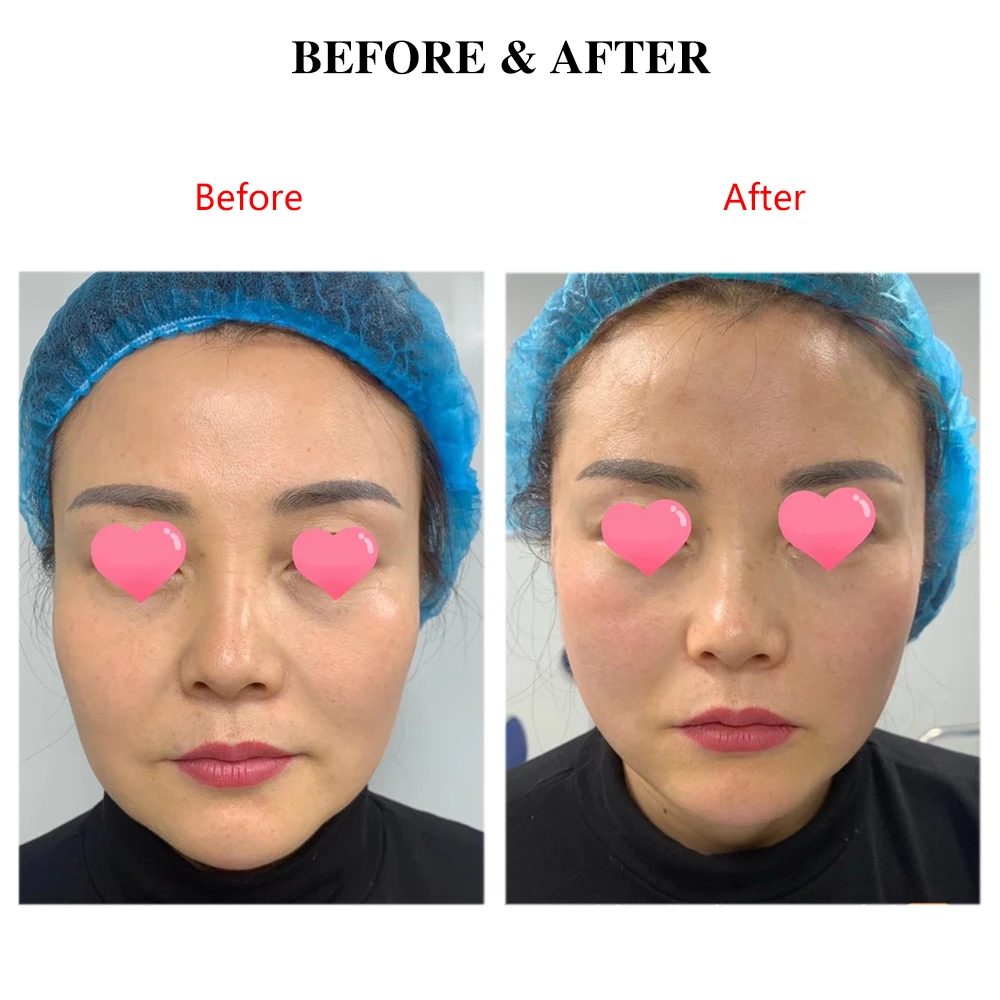 Best Seller Korea Sharp Needle 26g 50mm Mono PCL Thread For Wrinkles