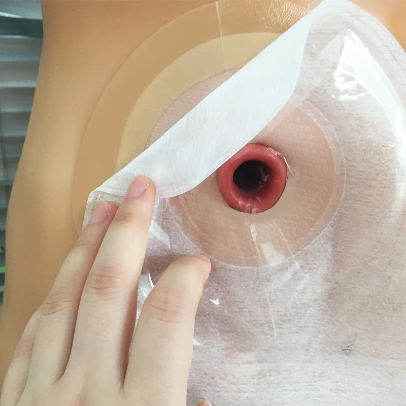 OEM Disposable Mouldable Ostomy Barrier Ring Flange Use For Colostomy Bag