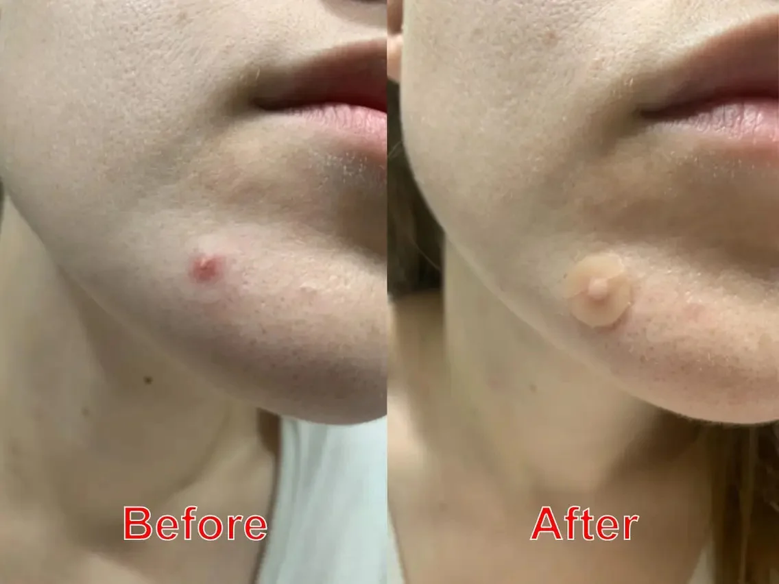 Oem Face Hydrocolloid Acne Sticker Invisible Full Face Pimple Spot Patches Clear Custom