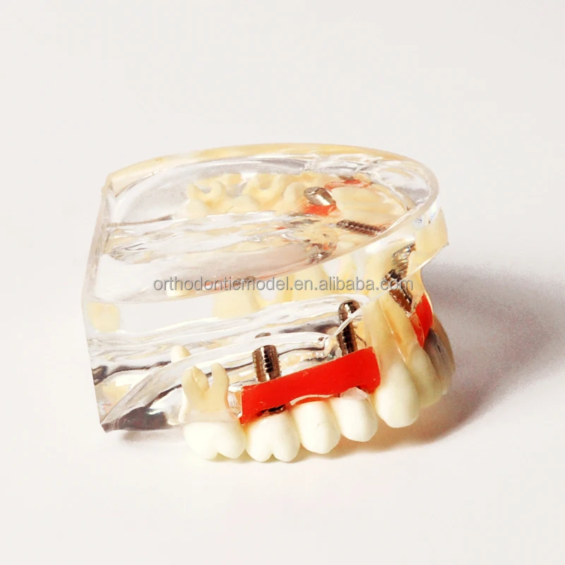 Демонстрационная модель имплантации с одной короной и мостом