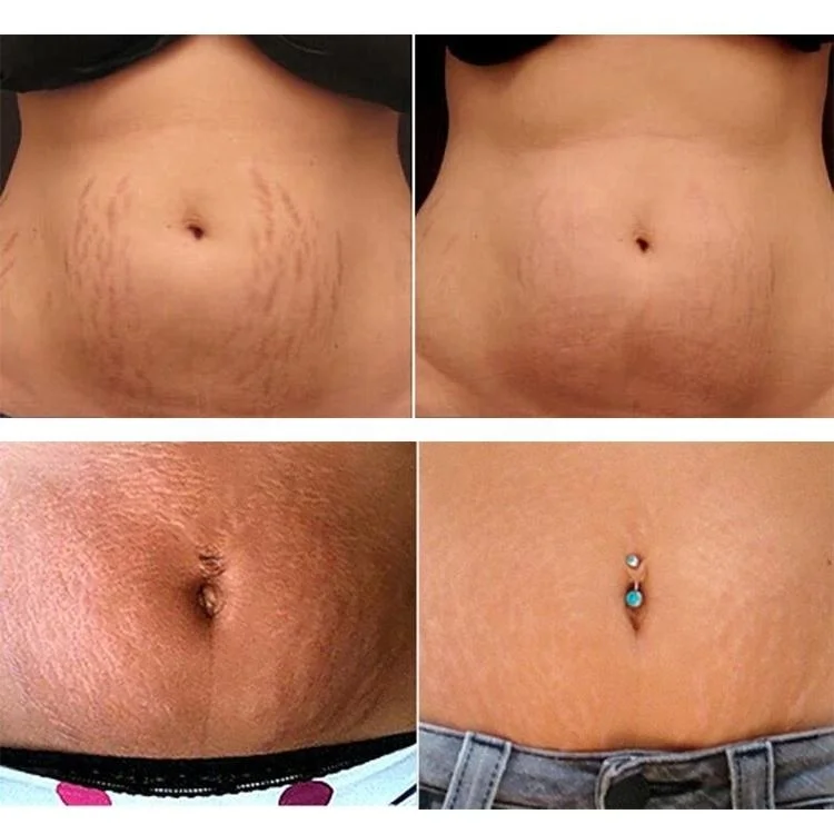 100ml Private Label Stretch Mark Scar Oil Vitamin E & Collagen Skin Firming Body Oil Stretch Mark Removal Oil