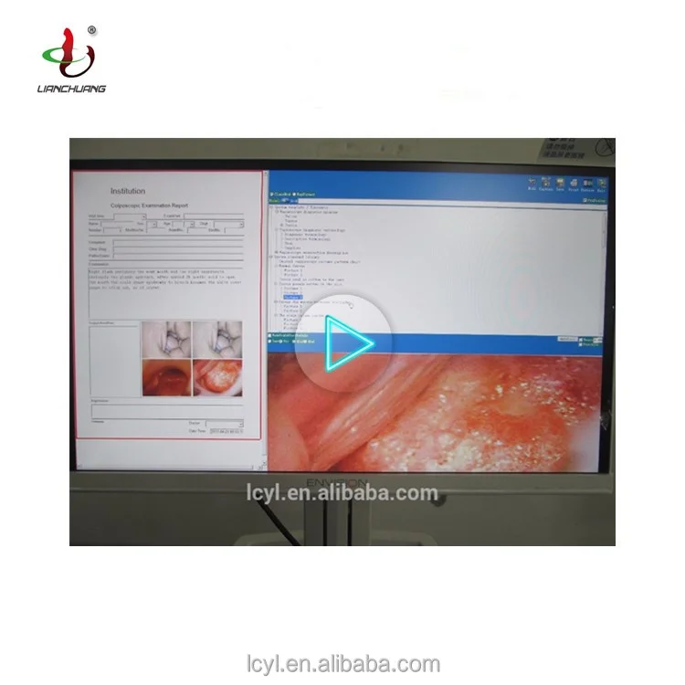 Portable vtype portable gynaecology equipment digital colposcope machine