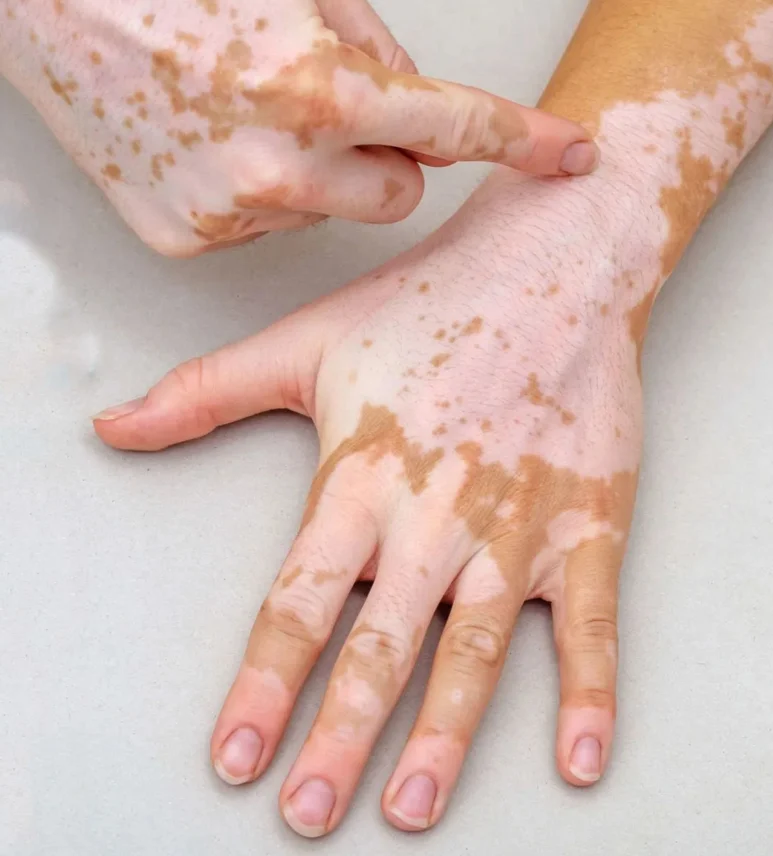 IBOOLO DE-215 Professional Woods Lamp Skin Pigmentation Analysis UVA Lamp Medical Magnifier Dermoscope for Clinical Use