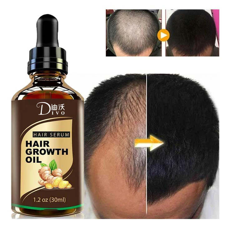 OEM 30ml Hair Loss Treatment Growth Oil Natural Hair Growth  Organic 7 Days Ginger Germinal Oil