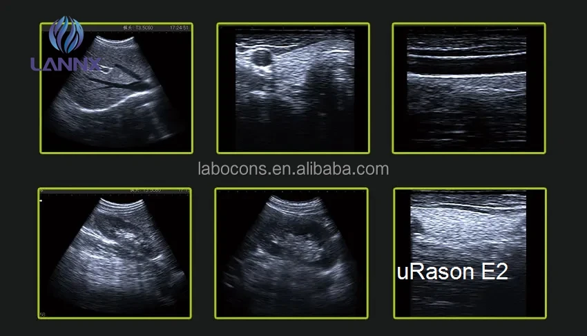 LANNX uRason E2 Human pregnancy ultrasonic diagnostic scanner echocardiography Medical Digital Ultrasound Machine ultrasonido