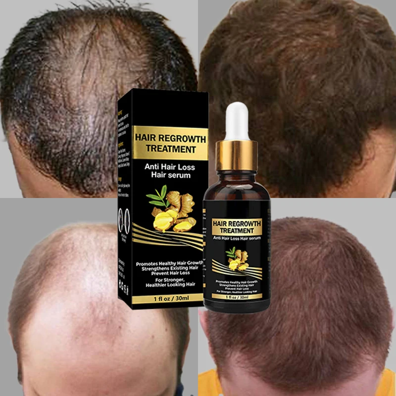 Free Sample OEM/ODM Natural Organic Oil Essential Biotin Serum Hair Growth Oil at Home For Men And Women