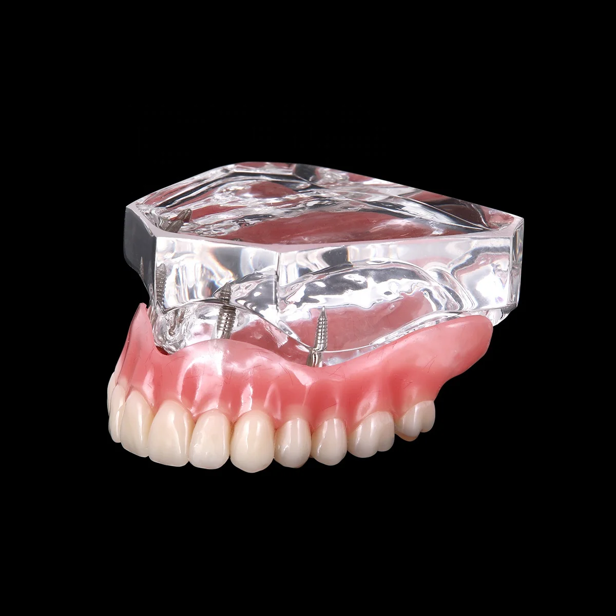 Hot Selling Dental Implant Teeth Model Overdenture Restoration with Implants Upper
