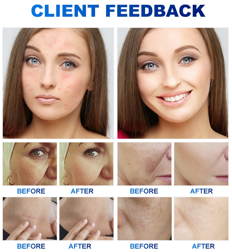 skin treatment full body powerful pdt 4 color light therapy beauty salon led facial therapy pdt infrared device