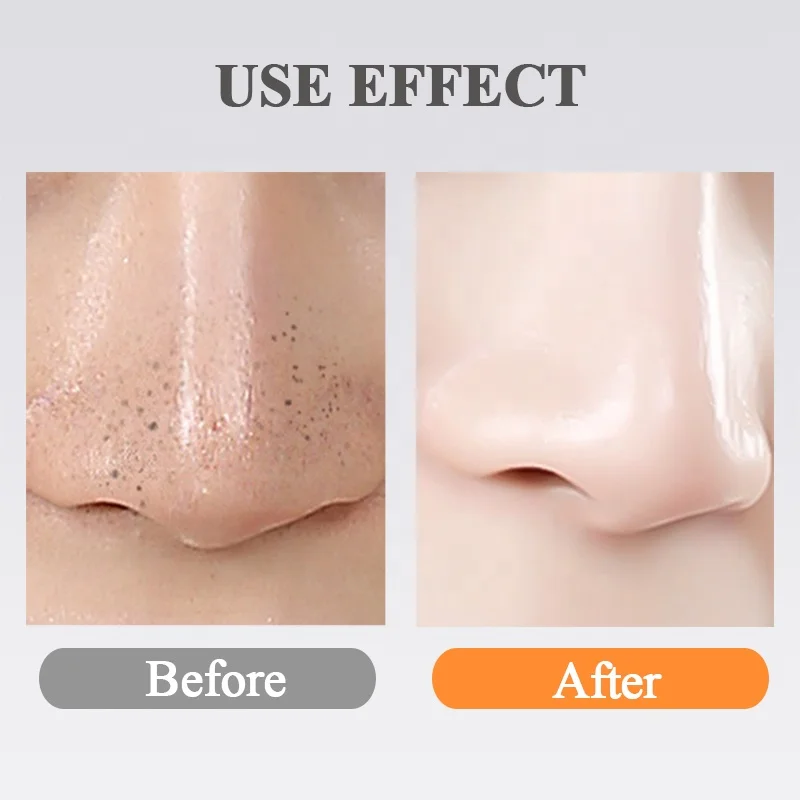 
2019 Top beauty device blackhead remover vacuum 