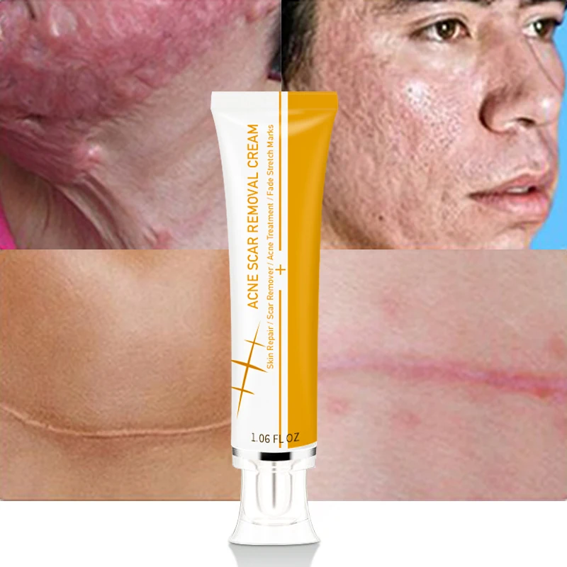 Private Label Pimples Stretch Marks Remove Face Gel Tummy Tuck Tightening Stretch Mark Removal Cream Acne Scar Removal Cream