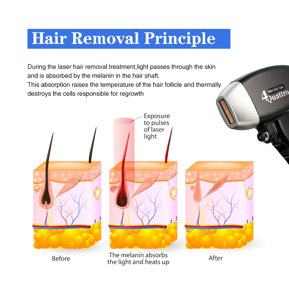 High Power Depilator Aesthetic Diode Removal Machine Laser Hair Removal 808nm 3 Wavelength Stationary 755nm 808nm 1064nm 